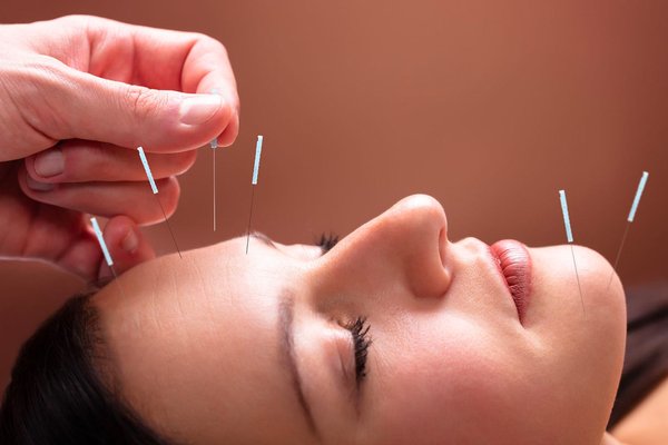 akupunktura-naturalny-sposob-odmladzania-twarzy